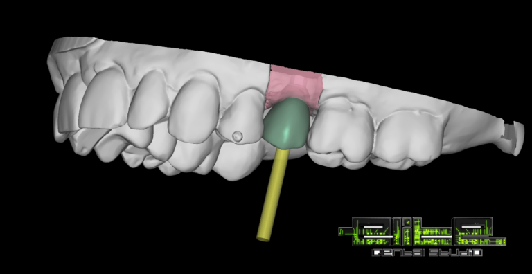 #elitedentalstudio #dentalimplants
